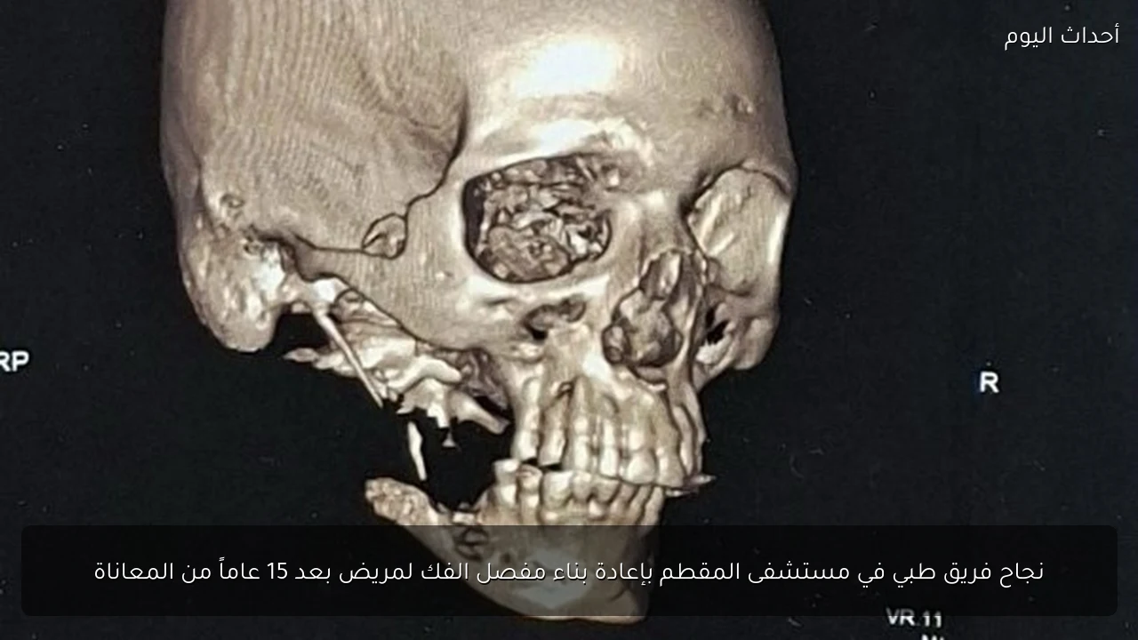 نجاح فريق طبي في مستشفى المقطم بإعادة بناء مفصل الفك لمريض بعد 15 عاماً من المعاناة