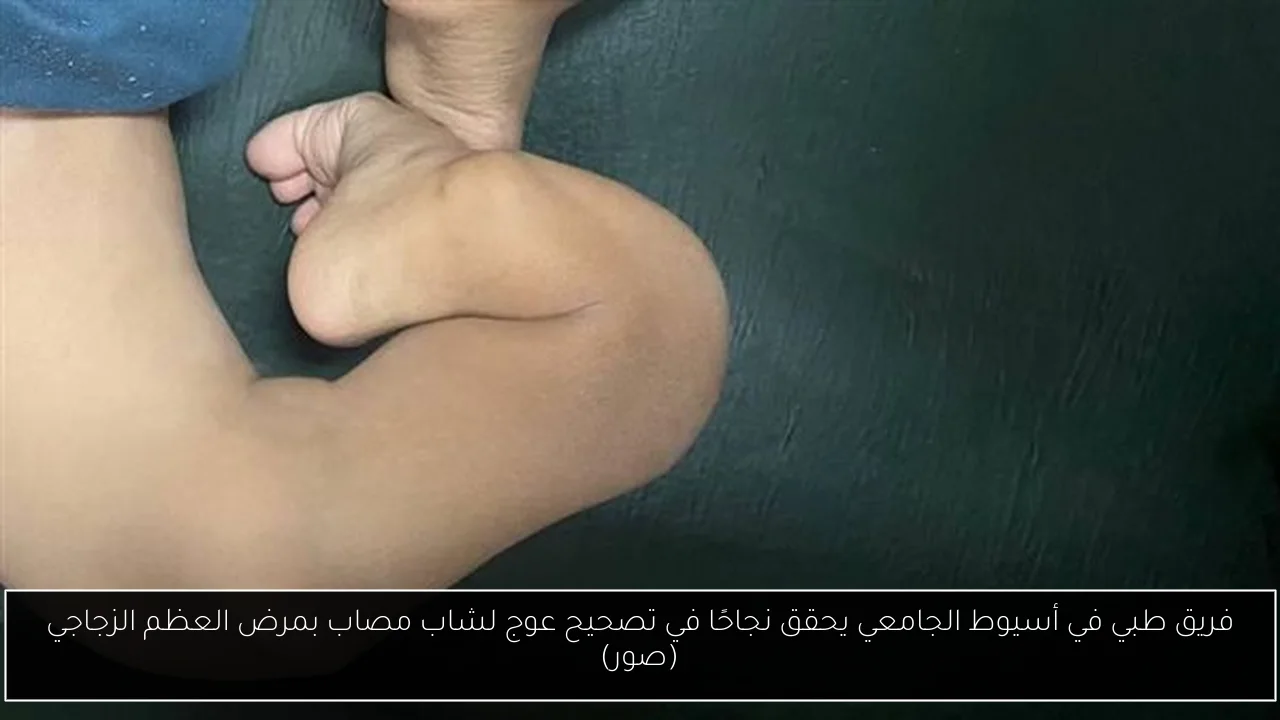 فريق طبي في أسيوط الجامعي يحقق نجاحًا في تصحيح عوج لشاب مصاب بمرض العظم الزجاجي (صور)