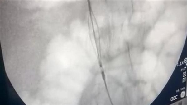 فريق جراحة الأوعية الدموية بمستشفيات قنا الجامعية ينجح في تدخل دقيق