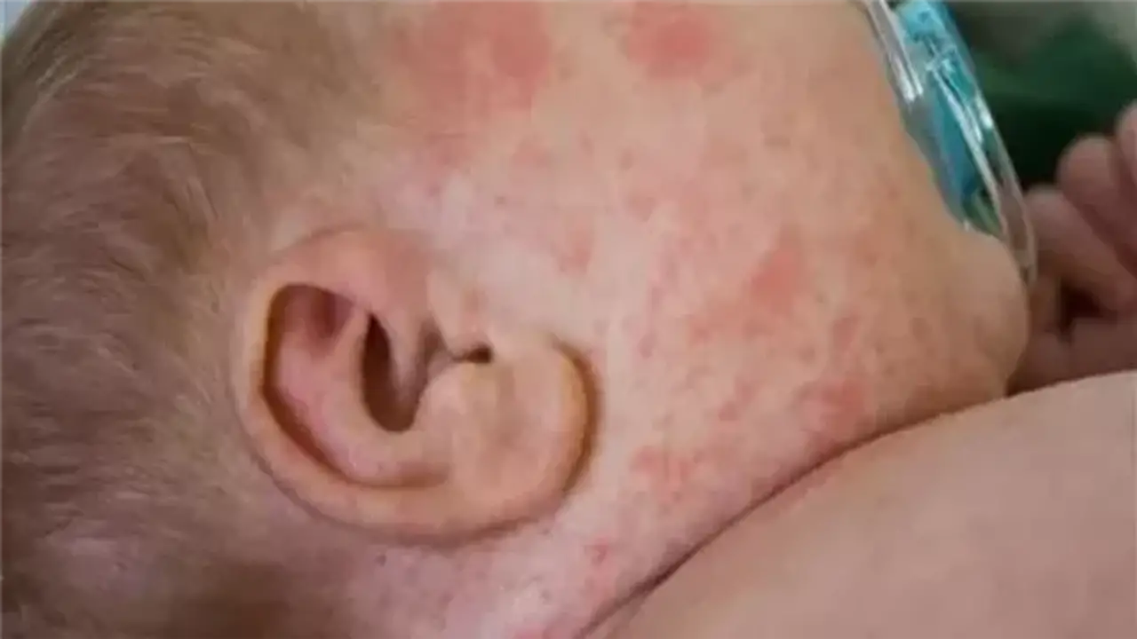 6 نصائح لحماية الأطفال من حمو النيل في الطقس الحار
