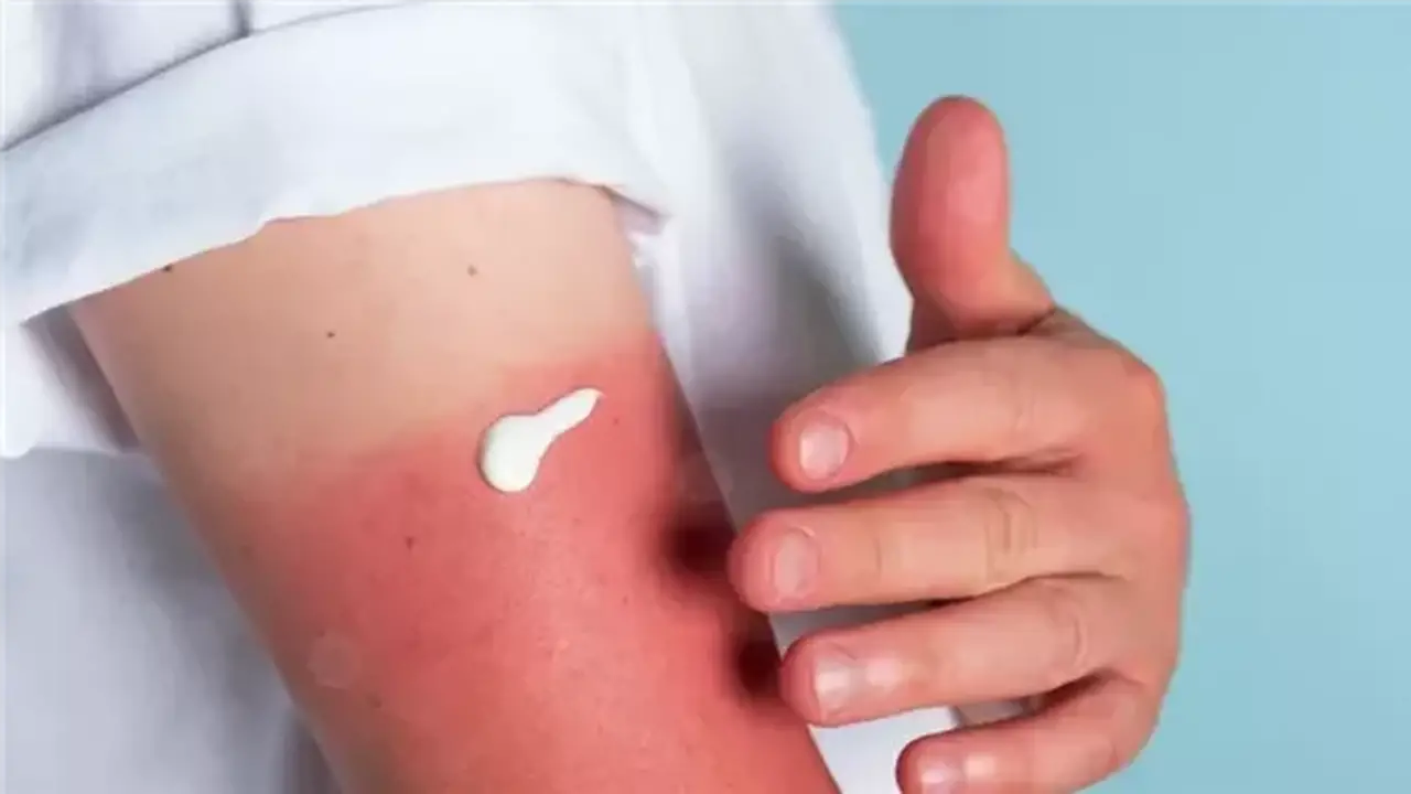 احذري.. كريم الشمس وحده لا يكفي لحماية طفلك من الحروق