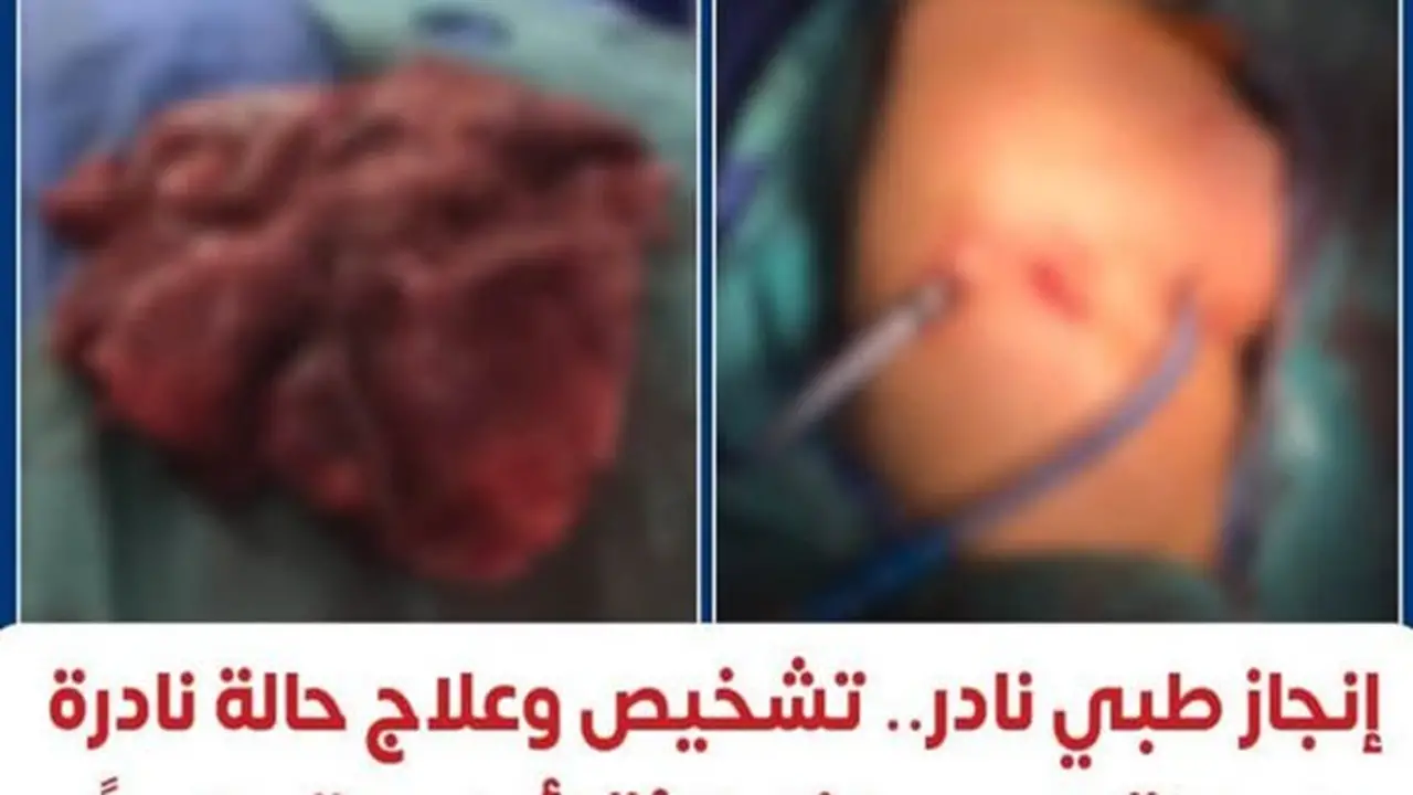 نجاح طبي غير مسبوق: معهد القلب يشخص ويعالج أول حالة موثقة عالميًا لبطانة الرحم داخل الرئة